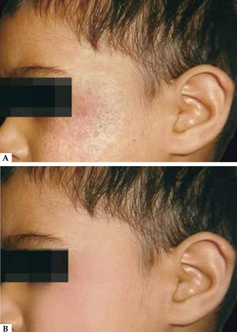 Light Therapy for Eczema What is it, and does it work? Heliotherapy Research Institute