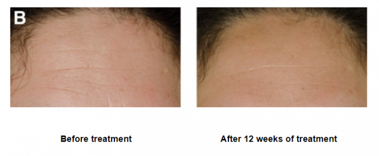 red light therapy reviews webmd