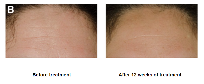 red light therapy results before and after