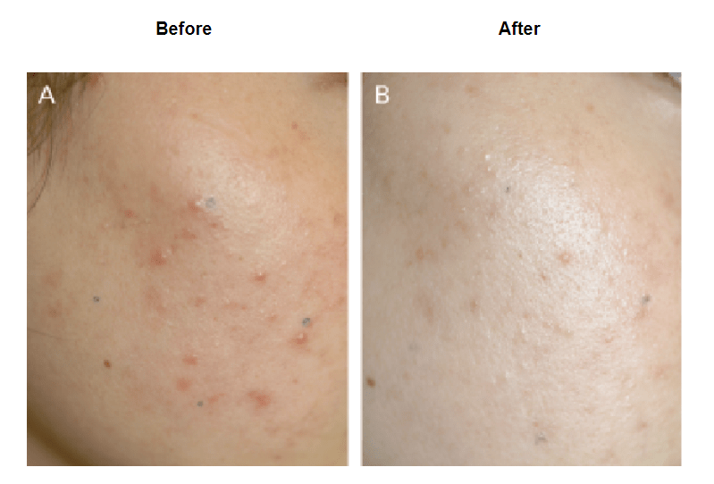 A 27-year-old woman with acne lesions before treatment (A) and 8 weeks after red light phototherapy (B), Right cheek, treated side; left cheek, control side. 
