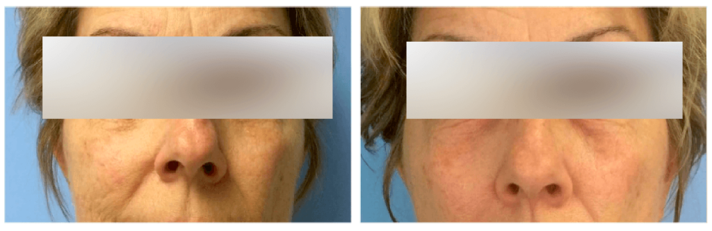 Before-after results of reducing age-related wrinkles (2 times a week after 4 weeks)