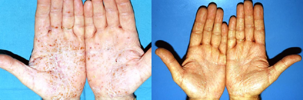 Improvement of the condition of a patient with palmoplantar psoriasis after treatment with PUVA therapy