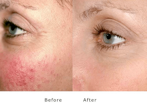Before/after the result of a patient with rosacea after applying green light therapy treatment