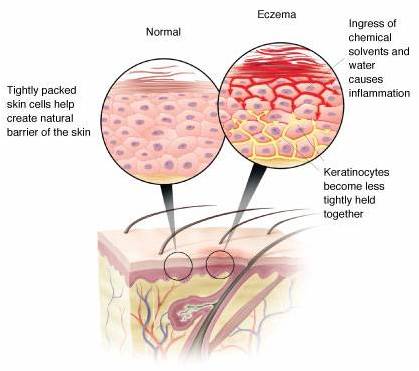 Eczema-affected skin