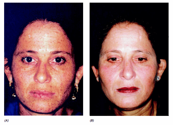 the appearance of lentigines on the face before and after treatment with therapy