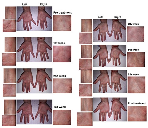 Non-atopic dermatitis in the hands: before, during, and after the sixth-week treatment with light therapy