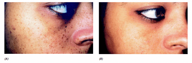 Freckles before and after treatment