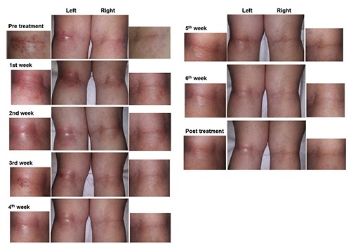 red light therapy eczema before and after