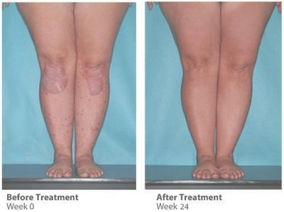 After 24 weeks of treatment for atopic dermatitis with ultraviolet phototherapy