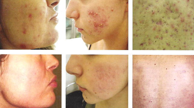 Result acne treatment with combined red and blue LED therapy