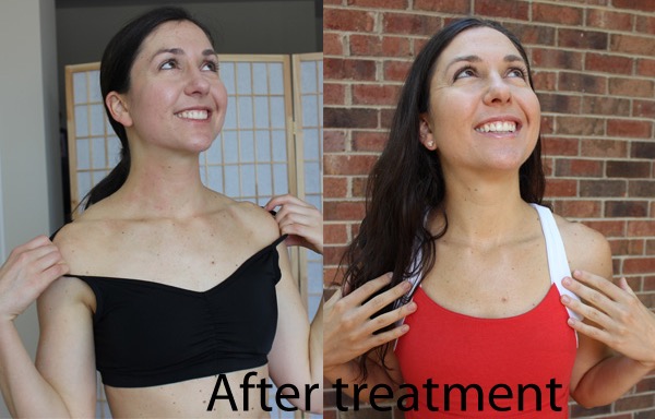 after phototherapy treatment