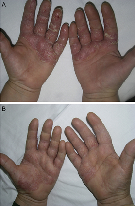 The result of using PUVA therapy for the treatment of palmoplantar psoriasis