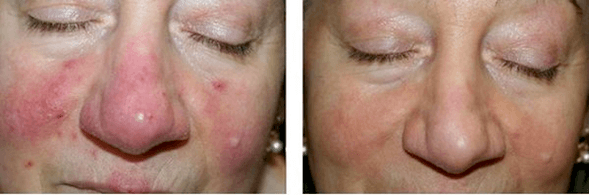 The result of green therapy treatment for signs of rosacea — superficial vascular lesions and erythema