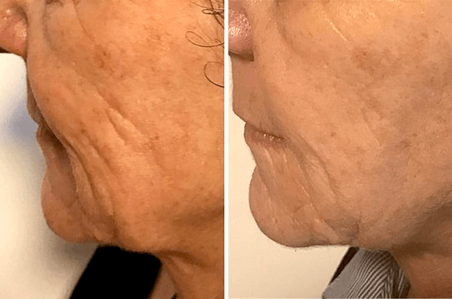 The result of treatment of age-related changes using LED therapy