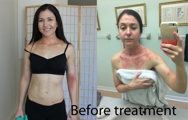 before phototherapy treatment