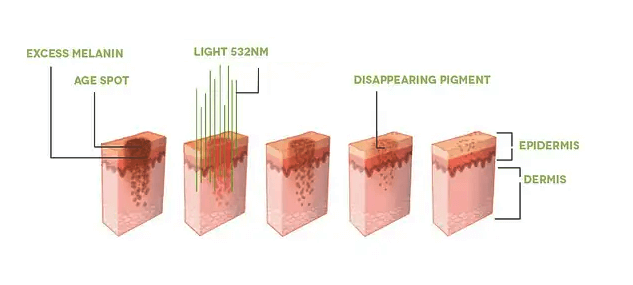 The energy of green light penetrates to a certain depth, deliberately destroying only the cells containing the melanin pigment