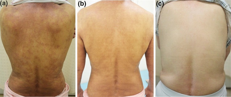 atopic dermatitis