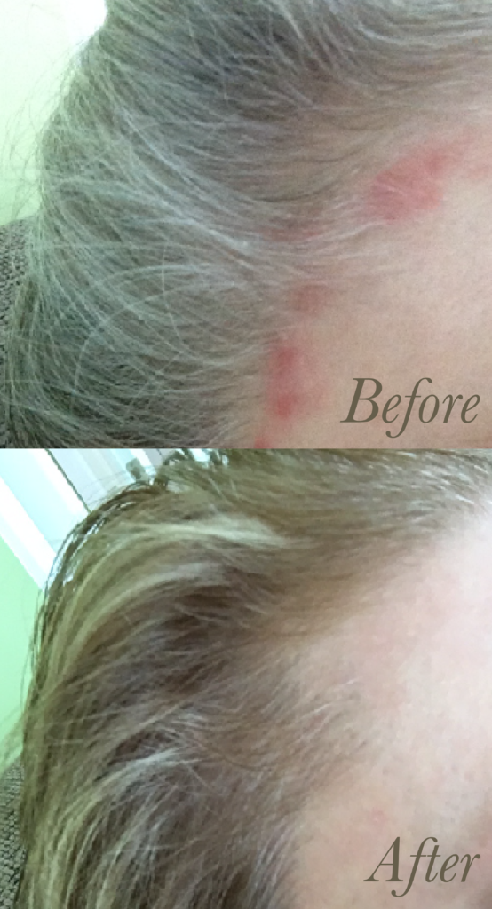 The result of acne treatment with red light therapy