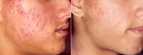 The result of acne treatment with blue light therapy (before/after 4 weeks)