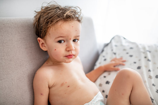 Infection (measles, chickenpox, rubella)