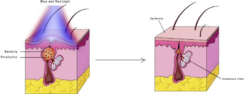 Аcne treatment with red and blue light