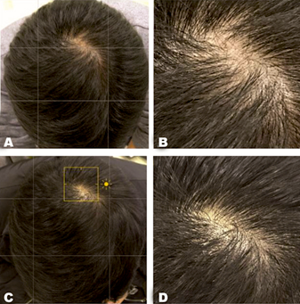 The result of laser hair loss treatment 