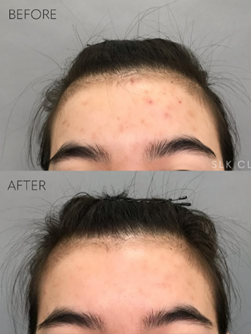 Before/after hairline acne red light therapy treatment