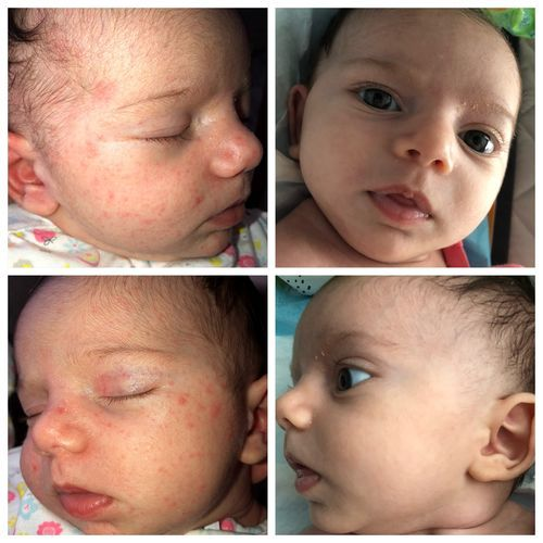 Before/after baby acne UVB light therapy treatment 