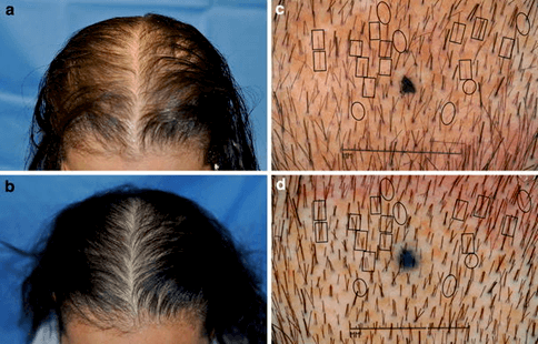 The result of a 26-week baldness treatment with a laser cap