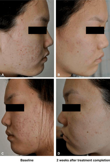 The result of acne treatment with blue light therapy