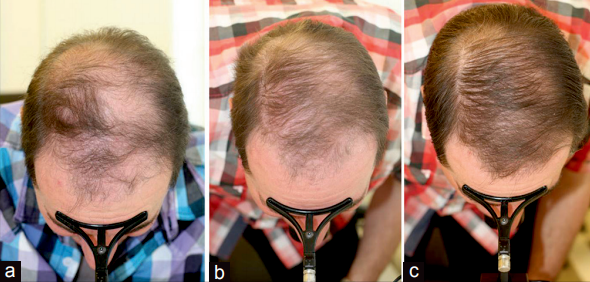 HairMax laser comb treatment result
