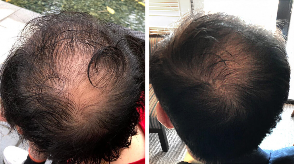 Before/after treatment of androgenetic alopecia with laser therapy Source: US National Library of Medicine, National Institutes of Health