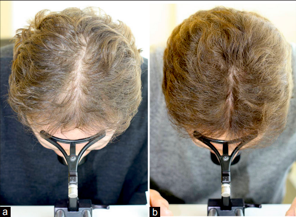 The result of treatment with the HairMax laser comb after 26 weeks Source: hairmax.com