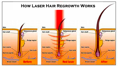 How laser therapy works for hair loss treatment