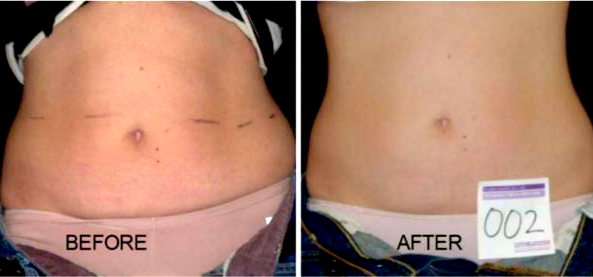 Abdomen before and after LLLT