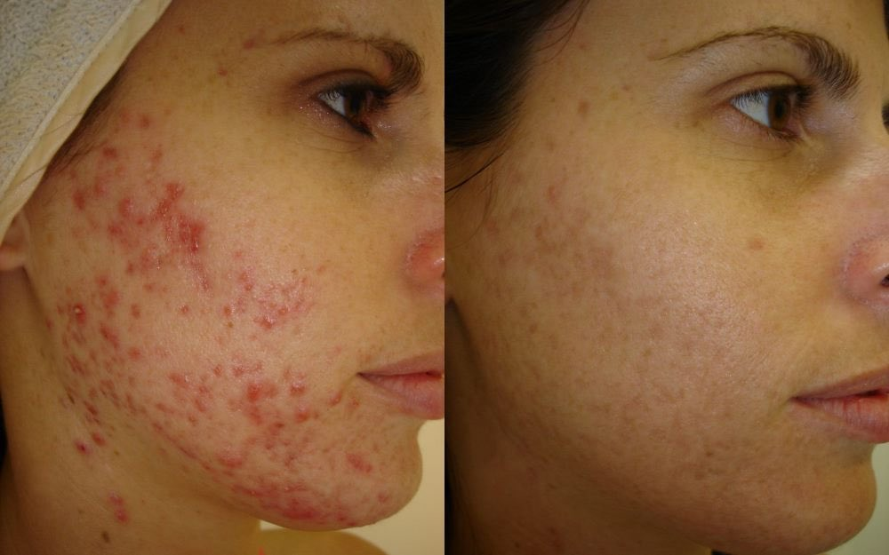 How does light therapy help textured skin?