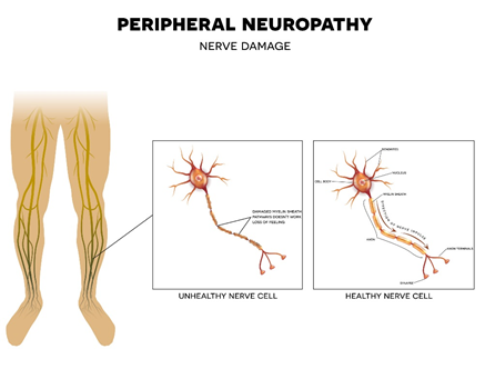 Nerve damage