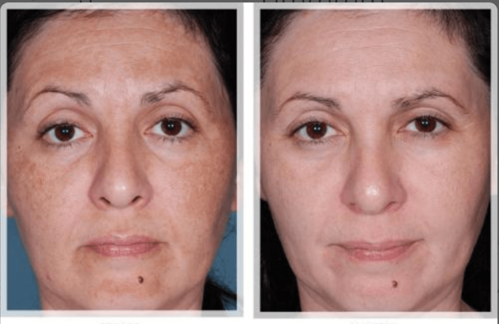 How does light therapy help textured skin?