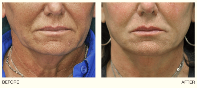 The result of reducing wrinkles and increasing skin elasticity using LLLT