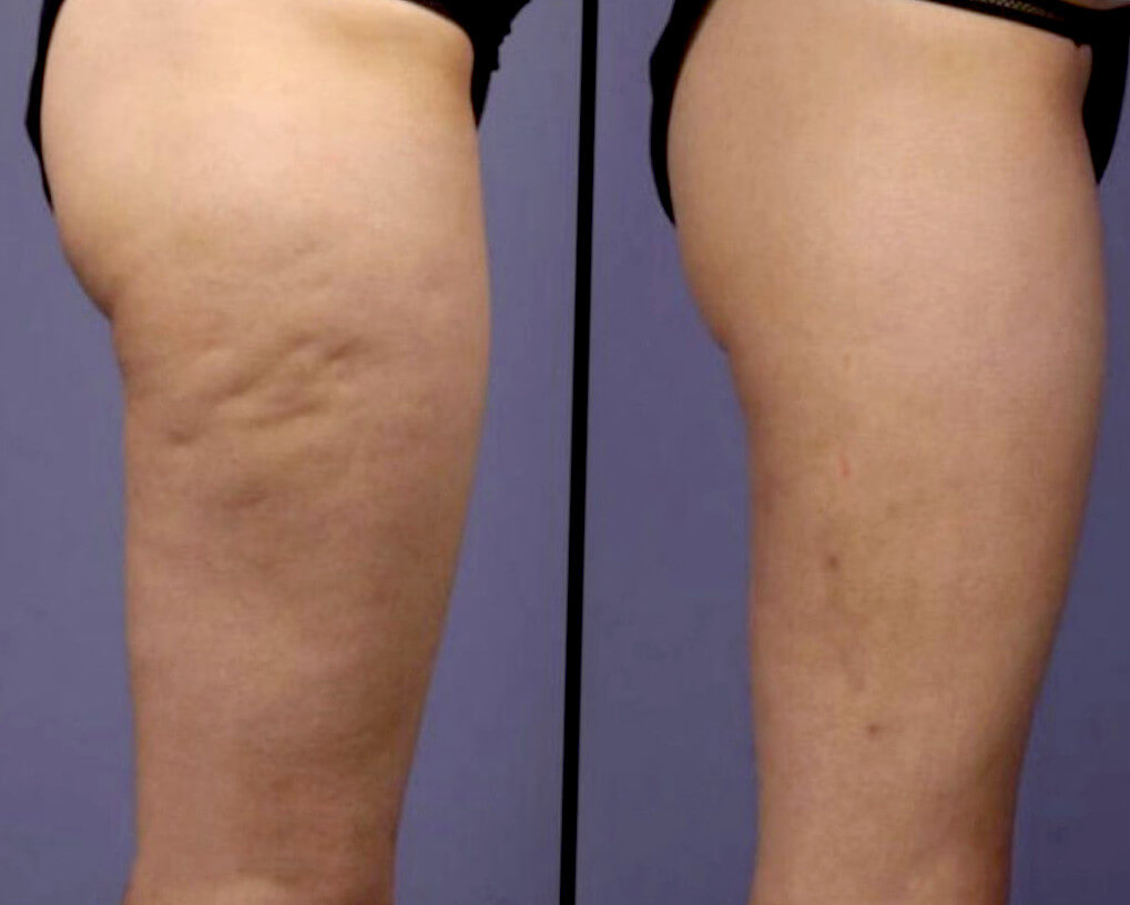 Cellulite reduction result after using ultrasonic cavitation machine