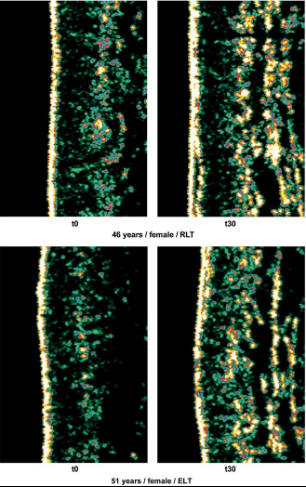 Increased collagen 