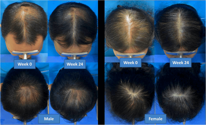 Result of laser hair loss therapy