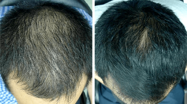 Result of laser hair loss therapy
