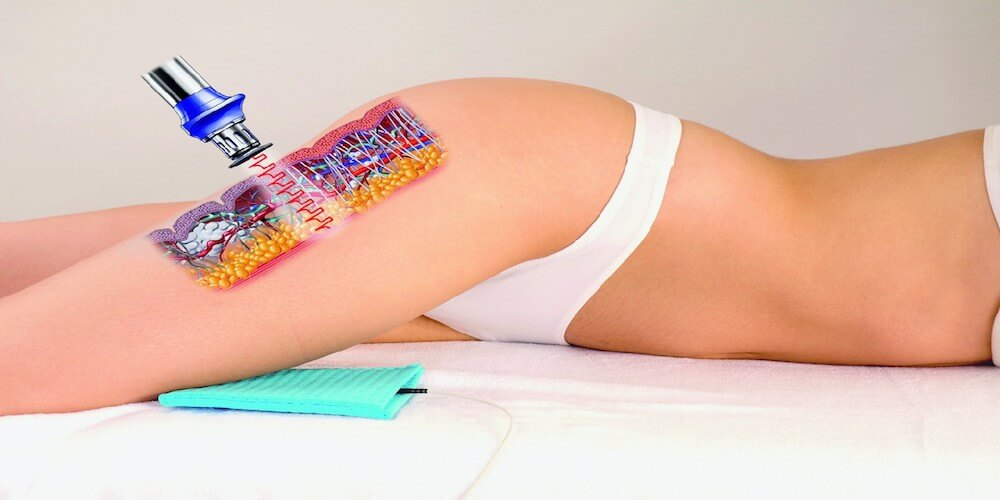 Cellulite treatment with laser therapy