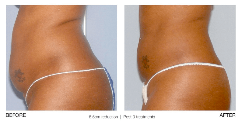 ultrasonic cavitation before and after stomach