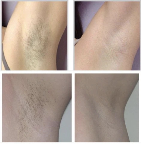 Before/after using the laser hair removal machine