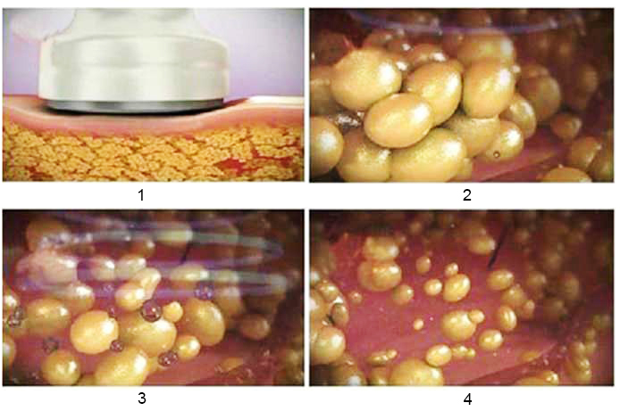 Fig 1: 1 — head of the cavitation machine is applied to the skin, 2 — adipose tissue is affected by the ultrasound waves, 3 — ultrasonic vibrations cause the formation of air bubbles, that burst and break membranes of adipose (fat cells), 4 — liquefied free fatty acids travel to be decomposed by the liver.