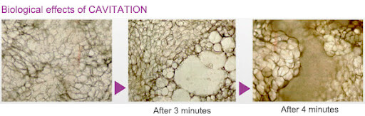 Fat tissue before and after ultrasonic cavitation