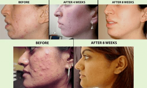 Treating acne with cold laser therapy 