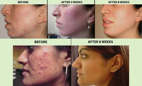 Treating acne with cold laser therapy 